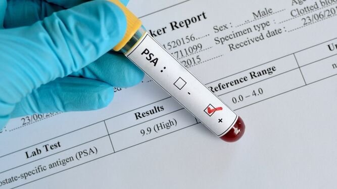 Imagen de Antígeno Prostático (PSA)